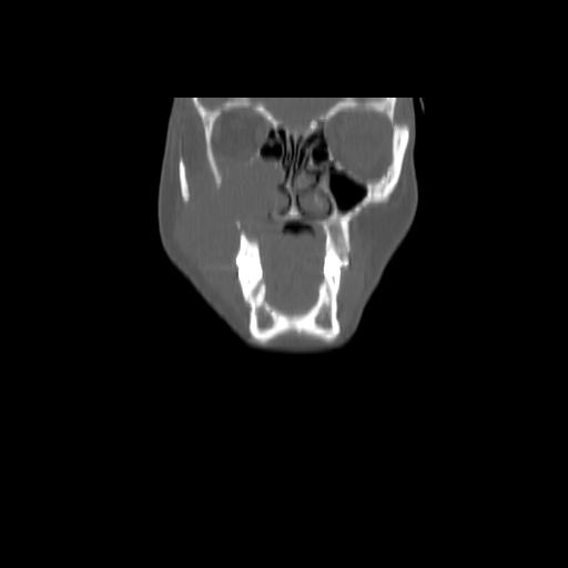 Carcinoma of the maxillary antrum (Radiopaedia 53805-59888 Coronal bone window 33).jpg