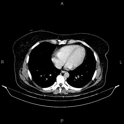 Carcinoma of uterine cervix (Radiopaedia 85861-101700 A 25).jpg