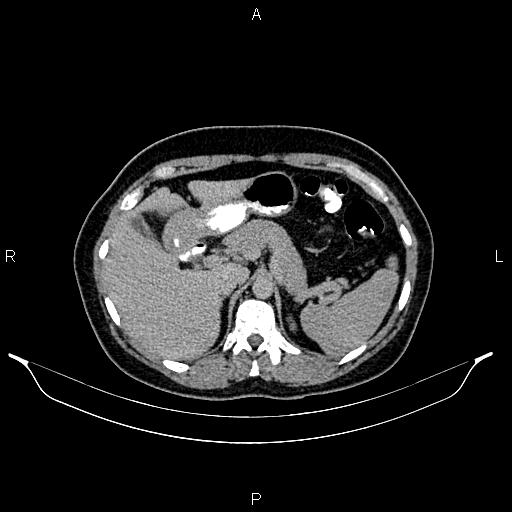 File:Carcinoma of uterine cervix (Radiopaedia 85861-101700 Axial C+ delayed 10).jpg