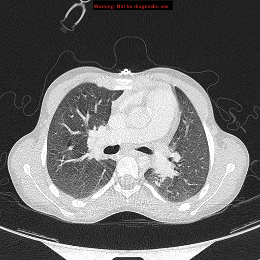 File:Cardiac bronchus (Radiopaedia 14059-13899 A 13).jpg