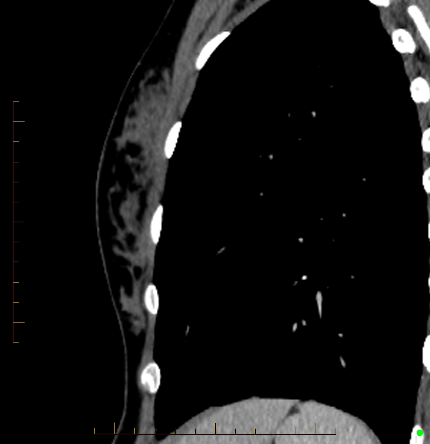 Cardiac paraganglioma (Radiopaedia 76345-88005 C 1).jpg