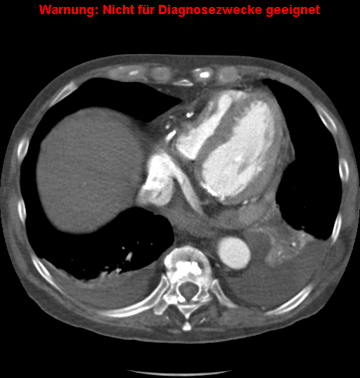File:Cardiac perforation following transcatheter aortic valve implantation (Radiopaedia 23714-23863 A 12).png