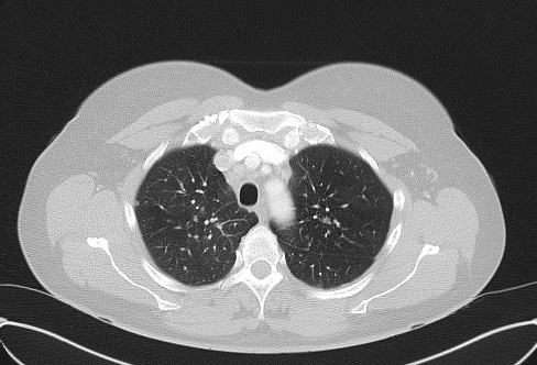 Cardiac sarcoidosis (Radiopaedia 74548-85534 Axial lung window 19).jpg