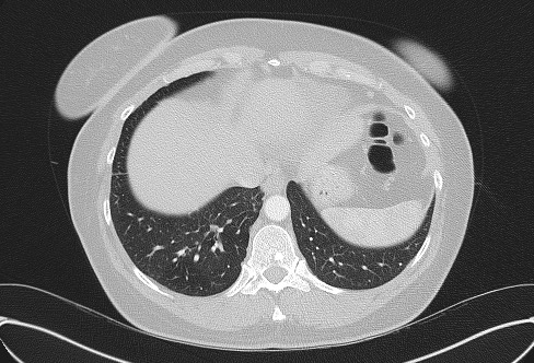 Cardiac sarcoidosis (Radiopaedia 74548-85534 Axial lung window 74).jpg