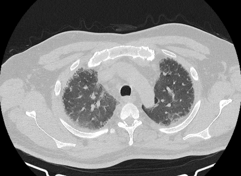 Cardiogenic pulmonary edema (Radiopaedia 68180-77678 Axial lung window 17).jpg