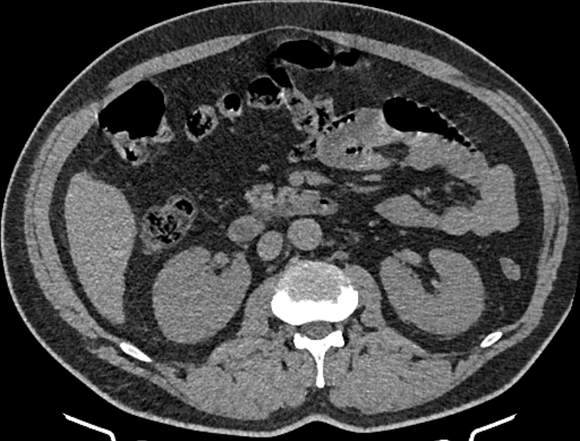 Cardiogenic pulmonary edema (Radiopaedia 68180-77678 Axial non-contrast 81).jpg