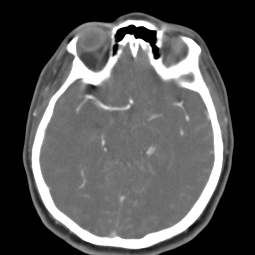 File:Carotico ophthalmic aneurysm (Radiopaedia 42916-46148 A 32).png