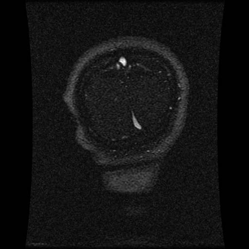Carotid arterial dissection with acute cerebral infarction (Radiopaedia 26636-26784 MRV 38).jpg