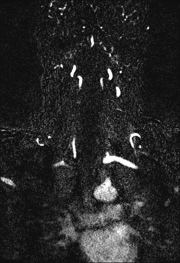 Carotid artery dissection (Radiopaedia 28441-28689 Coronal MRA 54).jpg