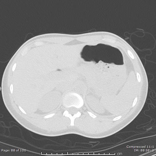 Catamenial pneumothorax (Radiopaedia 54382-60600 Axial non-contrast 88).jpg