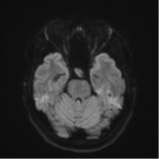 File:Cavernoma with bleed - midbrain (Radiopaedia 54546-60774 Axial DWI 36).png