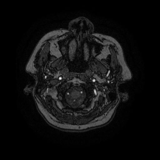 Cavernoma with developmental venous anomaly (Radiopaedia 22470-22507 MRA 101).jpg