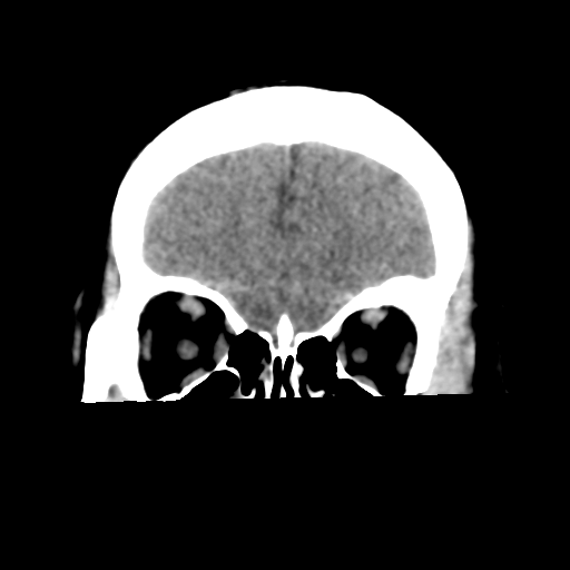 Cavernoma with hemorrhage (Radiopaedia 70755-80931 Coronal non-contrast 14).png