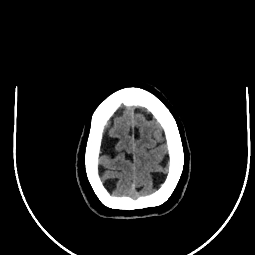 Cavernous hemangioma of the cerebellar falx (Radiopaedia 73025-83723 Axial non-contrast 124).jpg