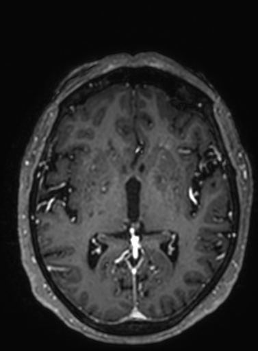 File:Cavernous hemangioma of the cerebellar falx (Radiopaedia 73025-83724 Axial T1 C+ 170).jpg