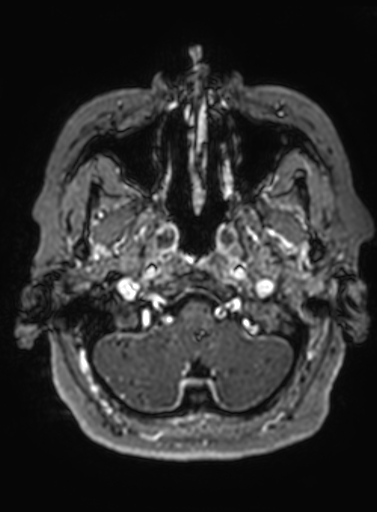 Cavernous hemangioma of the cerebellar falx (Radiopaedia 73025-83724 Axial T1 C+ 301).jpg