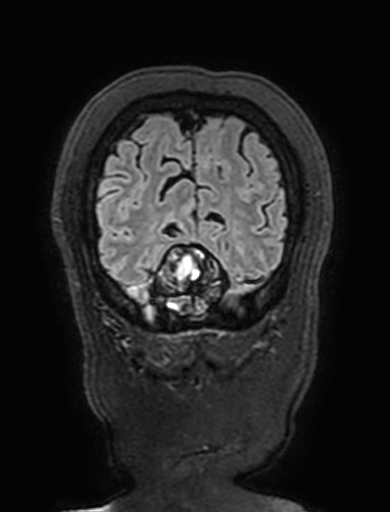 Cavernous hemangioma of the cerebellar falx (Radiopaedia 73025-83724 Coronal FLAIR 318).jpg