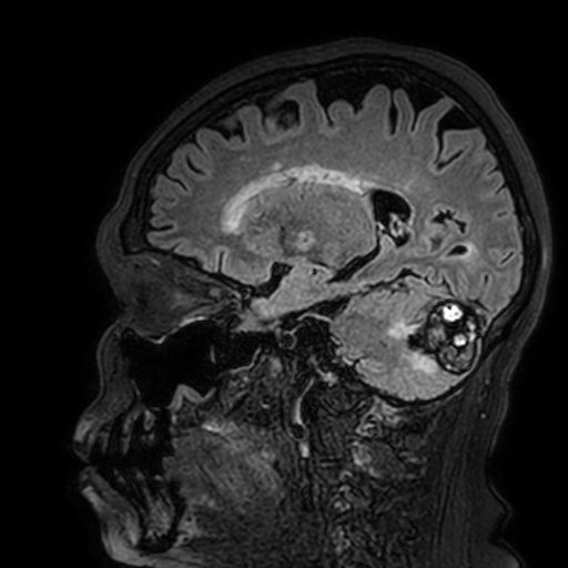 Cavernous hemangioma of the cerebellar falx (Radiopaedia 73025-83724 Sagittal FLAIR 141).jpg