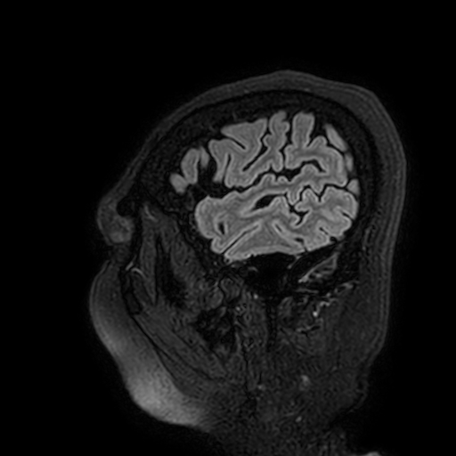 Cavernous hemangioma of the cerebellar falx (Radiopaedia 73025-83724 Sagittal FLAIR 19).jpg