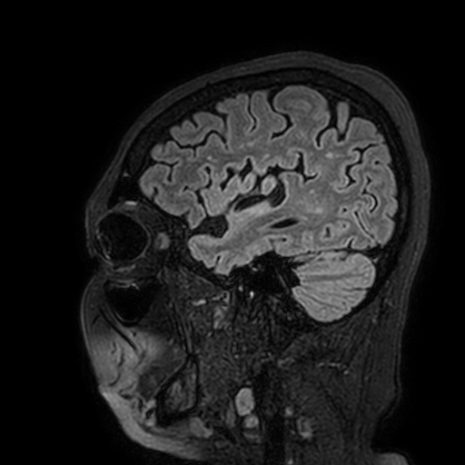 Cavernous hemangioma of the cerebellar falx (Radiopaedia 73025-83724 Sagittal FLAIR 41).jpg