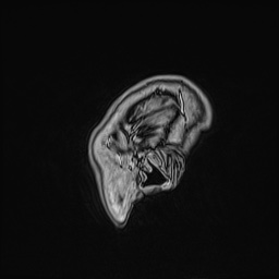 Cavernous sinus meningioma (Radiopaedia 63682-72367 Sagittal T1 C+ 163).jpg