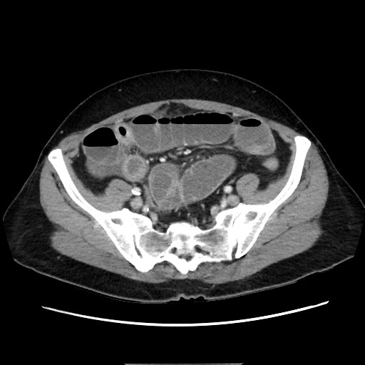 Cecal adenocarcinoma (Radiopaedia 75909-87331 A 68).jpg