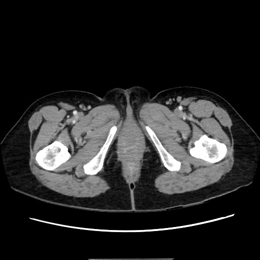Cecal adenocarcinoma (Radiopaedia 75909-87331 A 93).jpg