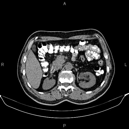 Cecal adenocarcinoma (Radiopaedia 85324-100916 Axial non-contrast 34).jpg