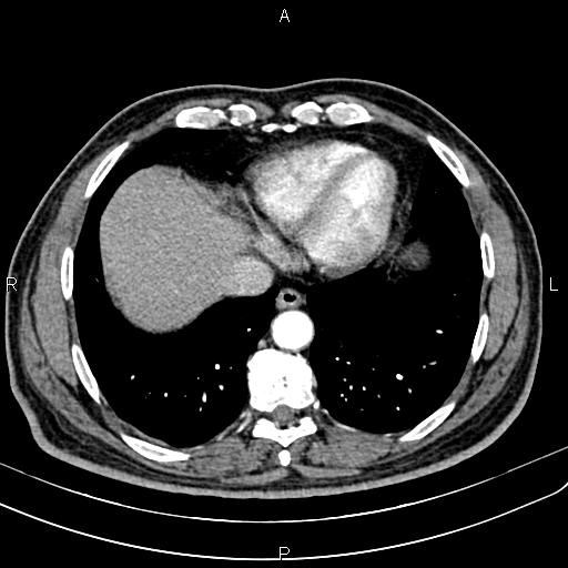 File:Cecal cancer with appendiceal mucocele (Radiopaedia 91080-108651 A 50).jpg
