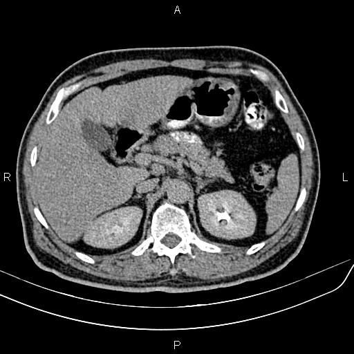 File:Cecal cancer with appendiceal mucocele (Radiopaedia 91080-108651 Axial C+ delayed 11).jpg