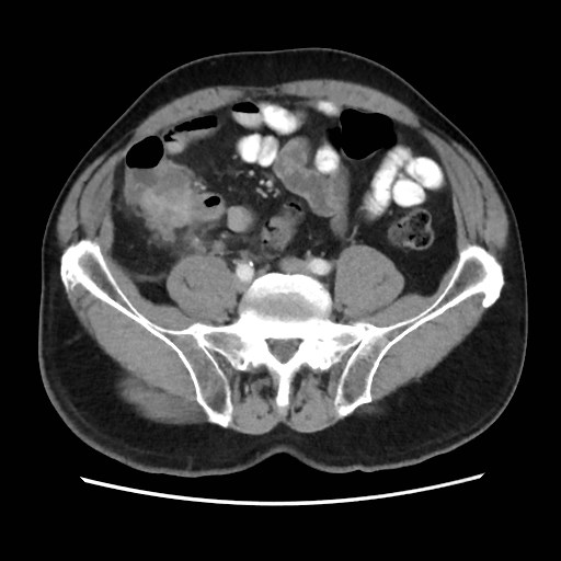 Cecal mass causing appendicitis (Radiopaedia 59207-66531 A 61).jpg