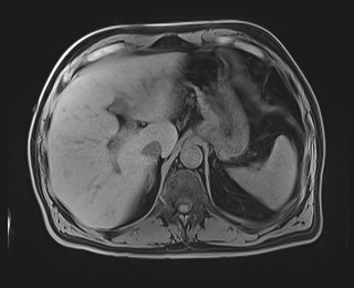 Cecal mass causing appendicitis (Radiopaedia 59207-66532 Axial T1 34).jpg