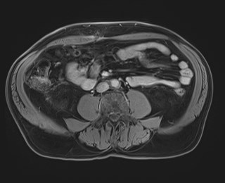 Cecal mass causing appendicitis (Radiopaedia 59207-66532 T1 C+ PV phase 80).jpg