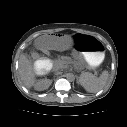 Cecal volvulus (Radiopaedia 28294-28534 Axial non-contrast 22).jpg