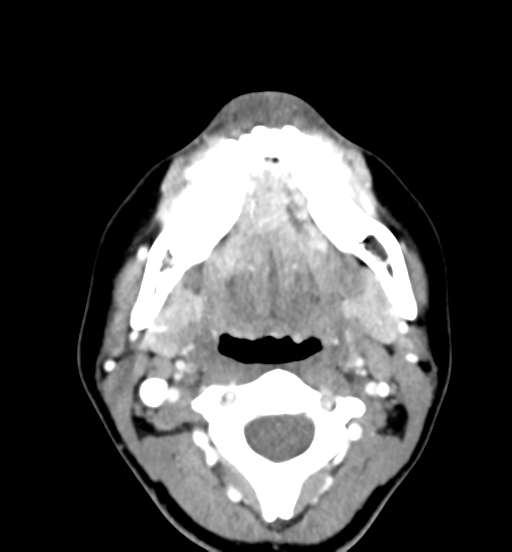 File:Cemento-ossifying fibroma (Radiopaedia 46243-50643 Axial C+ delayed 40).png