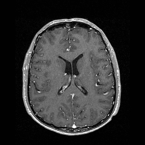Central-variant posterior reversible encephalopathy syndrome (PRES) (Radiopaedia 43880-47358 Axial T1 C+ 98).jpg