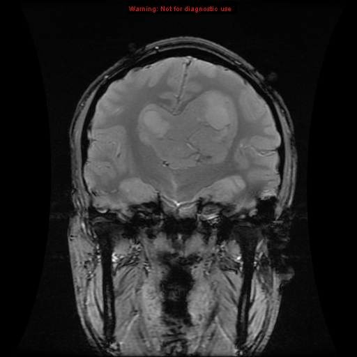 File:Central neurocytoma (Radiopaedia 13188-13206 G 8).jpg