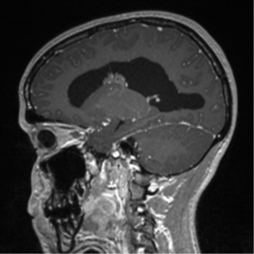 Central neurocytoma (Radiopaedia 37664-39557 Sagittal T1 C+ 37).png