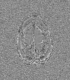 Central neurocytoma (Radiopaedia 84497-99872 Axial 66).jpg