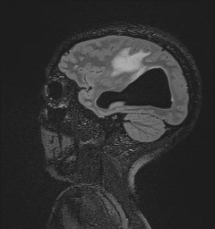 File:Central neurocytoma (Radiopaedia 84497-99872 Sagittal Flair + Gd 111).jpg