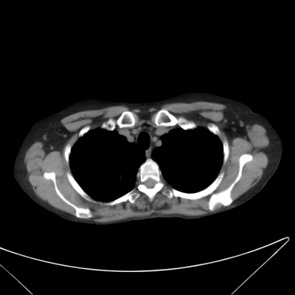 Centrilobular pulmonary emphysema (Radiopaedia 24495-24789 Axial non-contrast 7).jpg