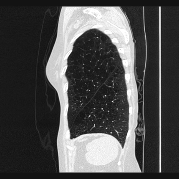 Centrilobular pulmonary emphysema (Radiopaedia 24495-24789 Sagittal lung window 75).jpg