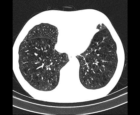 Centrilobular pulmonary emphysema (Radiopaedia 62468-70718 Axial lung window 57).jpg