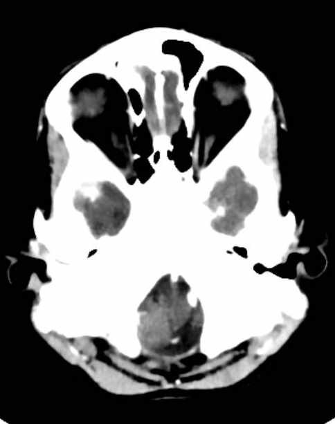 Cerebellar abscess (Radiopaedia 73727-84527 Axial C+ 11).jpg