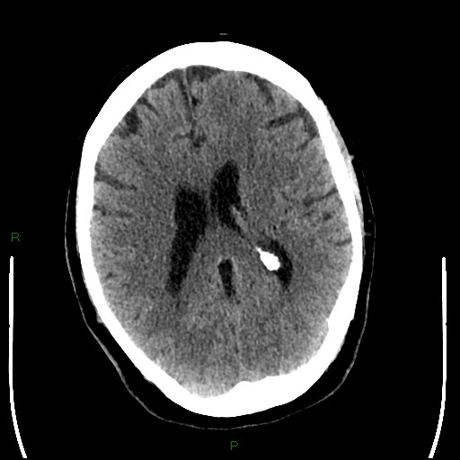 File:Cerebellar abscess (Radiopaedia 78135-90671 Axial non-contrast 65).jpg