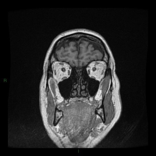 Cerebellar abscess (Radiopaedia 78135-90678 Coronal T1 C+ 25).jpg