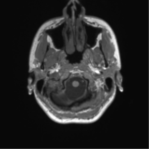 File:Cerebellar agenesis with hypoplastic pons (pontocerebellar hypoplasia) (Radiopaedia 57224-64138 Axial T1 10).png