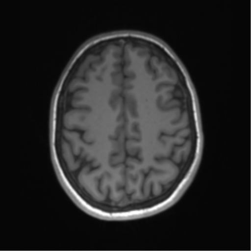 File:Cerebellar agenesis with hypoplastic pons (pontocerebellar hypoplasia) (Radiopaedia 57224-64138 Axial T1 57).png