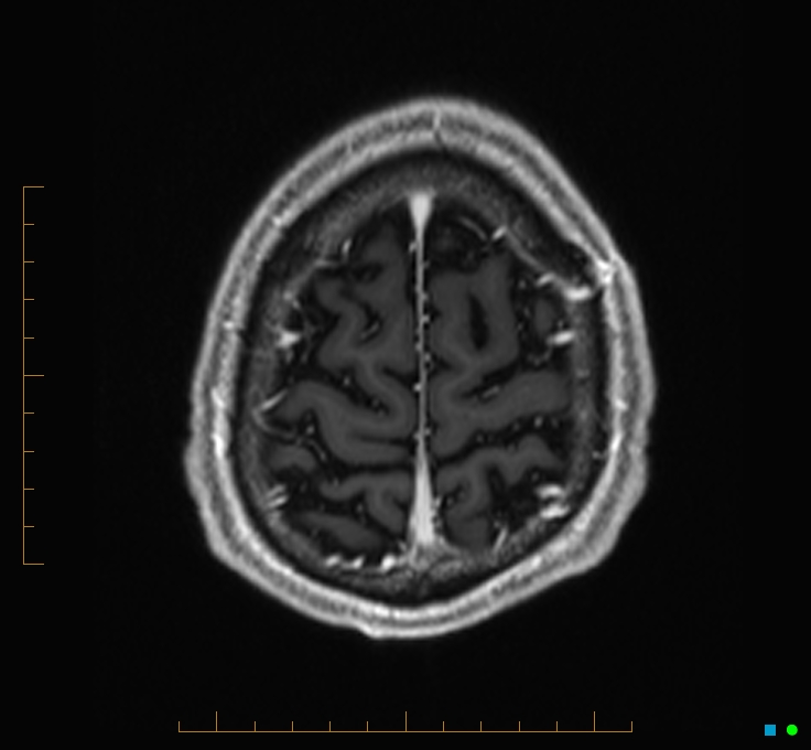 Cerebellar gangliocytoma (Radiopaedia 65377-74422 Axial T1 C+ 129).jpg