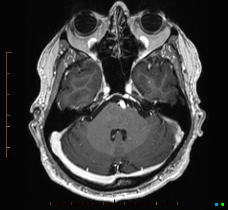 Cerebellar gangliocytoma (Radiopaedia 65377-74422 Axial T1 C+ 29).jpg